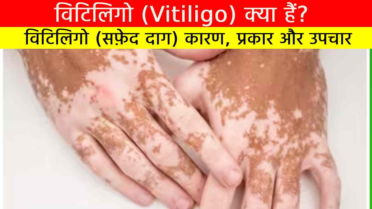 विटिलिगो (Vitiligo)