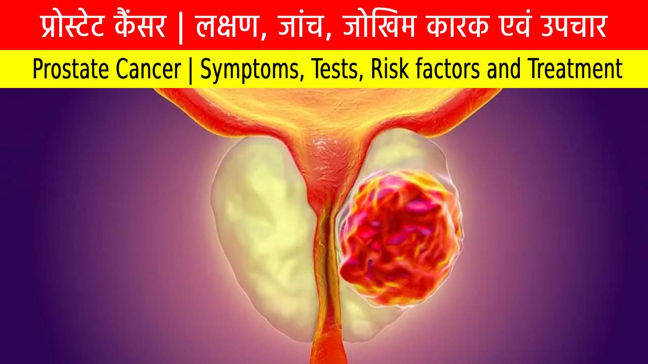प्रोस्टेट कैंसर