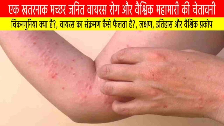 चिकनगुनिया: एक खतरनाक मच्छर जनित वायरस रोग