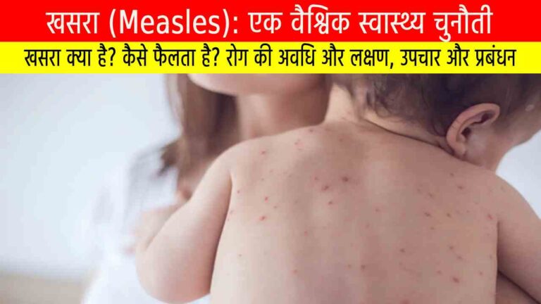 खसरा (Measles): एक वैश्विक स्वास्थ्य चुनौती